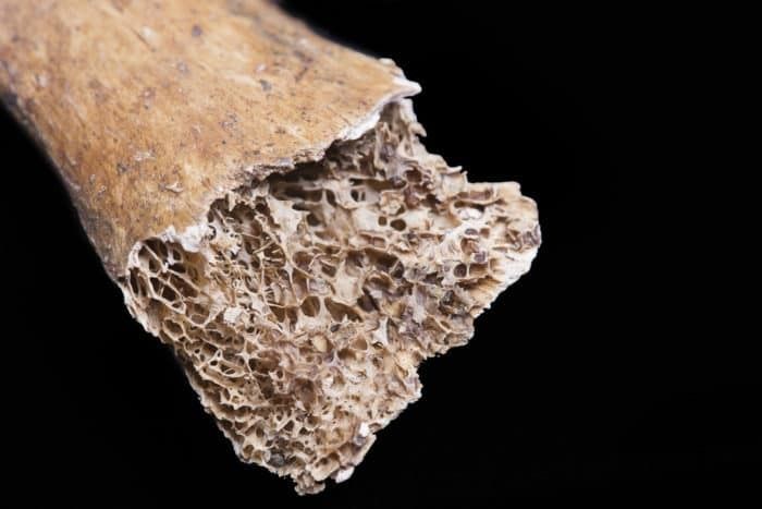 Sarcopenia: una complicación crónica en Diabetes mellitus tipo 2