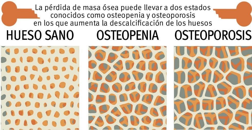 Sarcopenia: una complicación crónica en Diabetes mellitus tipo 2