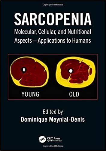Sarcopenia: una complicación crónica en Diabetes mellitus tipo 2