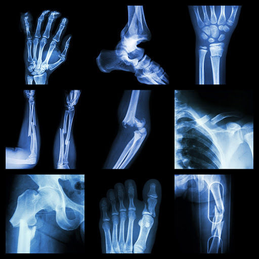 Sarcopenia: una complicación crónica en Diabetes mellitus tipo 2
