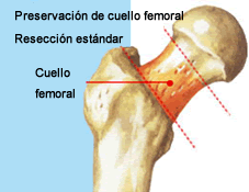 Sarcopenia: una complicación crónica en Diabetes mellitus tipo 2