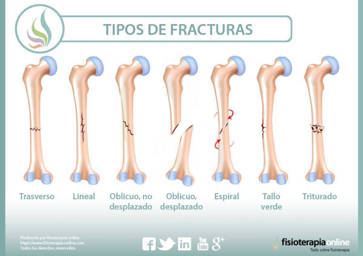 Sarcopenia: una complicación crónica en Diabetes mellitus tipo 2