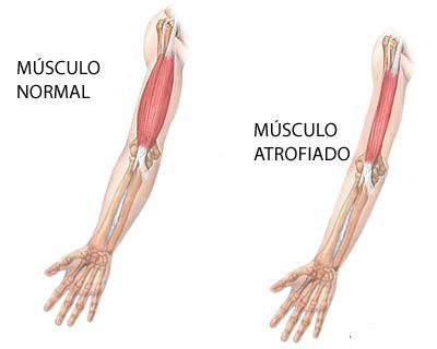 Sarcopenia: una complicación crónica en Diabetes mellitus tipo 2