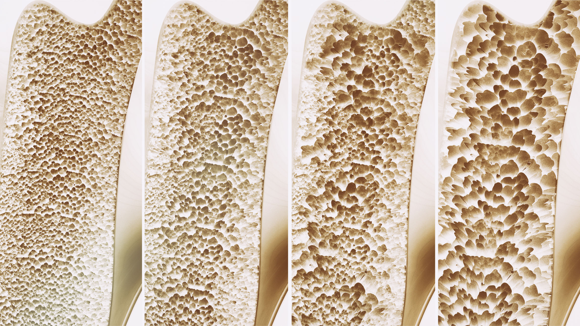 Sarcopenia: una complicación crónica en Diabetes mellitus tipo 2