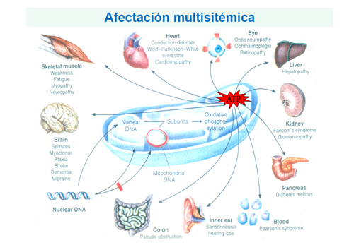 Sarcopenia: una complicación crónica en Diabetes mellitus tipo 2