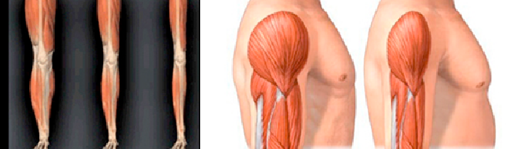 Sarcopenia: una complicación crónica en Diabetes mellitus tipo 2