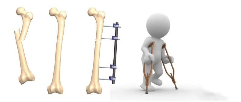 Sarcopenia: una complicación crónica en Diabetes mellitus tipo 2
