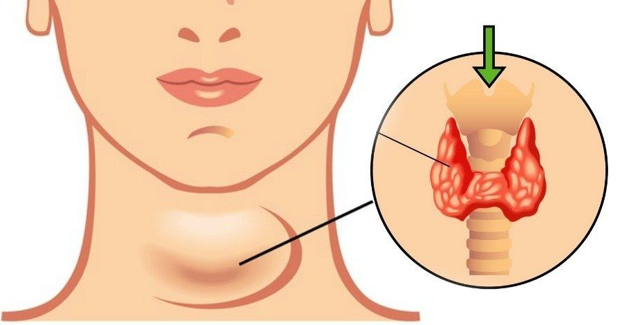 Sarcopenia: una complicación crónica en Diabetes mellitus tipo 2