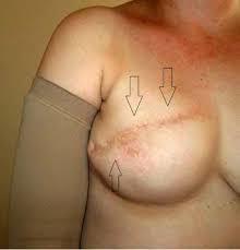 MASTECTOMIA