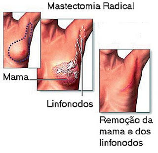 MASTECTOMIA