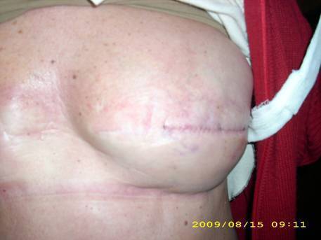 MASTECTOMIA