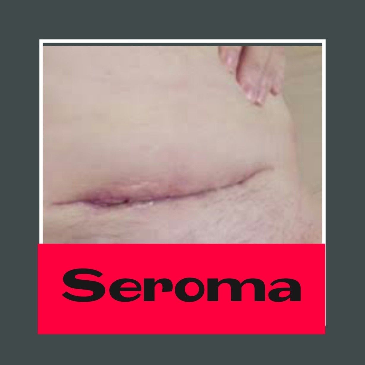 MASTECTOMIA