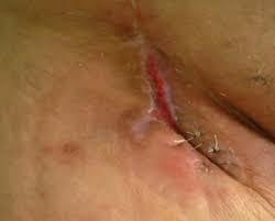 MASTECTOMIA