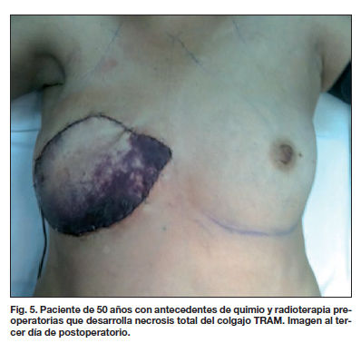 MASTECTOMIA