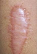 MASTECTOMIA