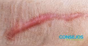 MASTECTOMIA