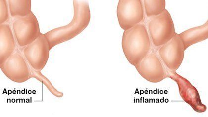 Es una inflamación del apéndice, un pequeño saco adherido al intestino grueso El síntoma es un fuerte dolor abdominal El tratamiento es l...