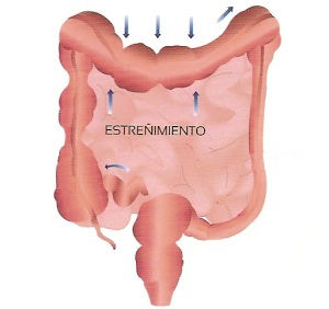 Es la dificultad para evacuar las heces Ocurre porque los movimientos del intestino son muy lentos Para prevenir se debe consumir una die...
