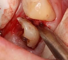 Raíces Fracturadas