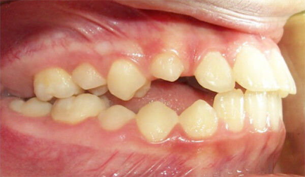 Extracción de dientes anquilosados