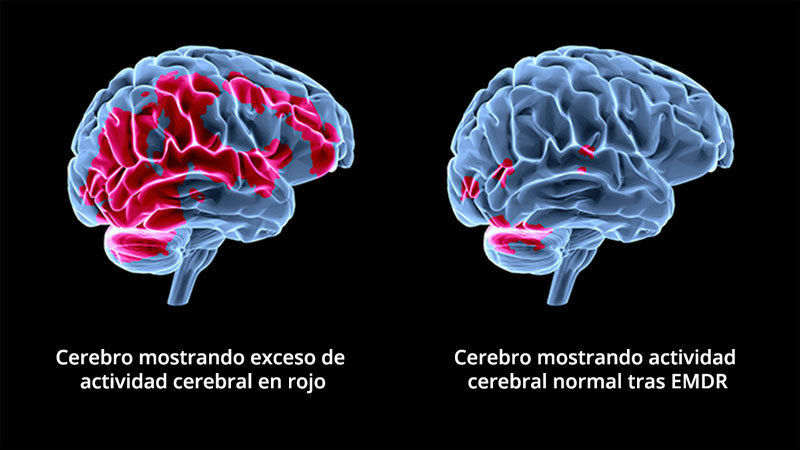 Desensibilización y reprocesamiento por medio de movimiento ocular (EMDR)