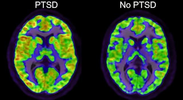 Desensibilización y reprocesamiento por medio de movimiento ocular (EMDR)