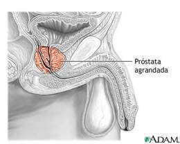 El causante de retención urinaria aguda o crónica en la Hiperplasia prostática benigna es:
