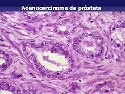 Adenocarcinoma prostático