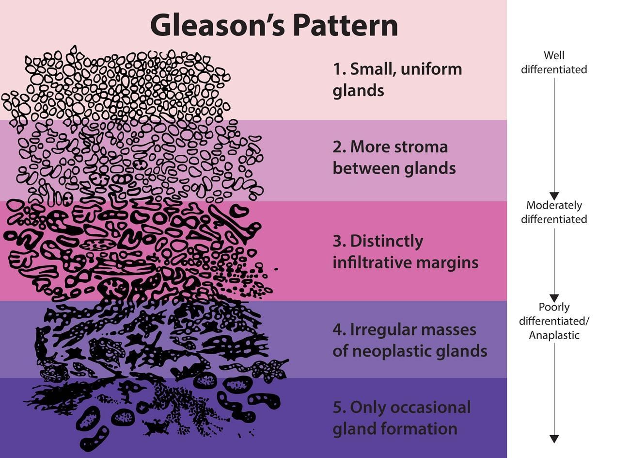 Los 5 grados según el Sistema de estadificación de Gleason