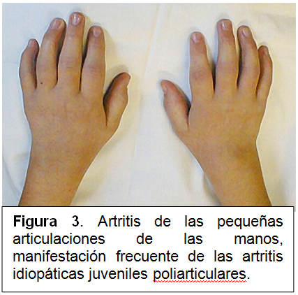 ARTRITIS IDIOPÁTICA JUVENIL Sandra Ventura Vargas