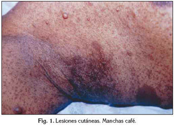 neurofibromatosis tipo 1 enf. multisitemica Rasopatias 1:2500 rnv autosomica dominante mutacion NF1 cromo.17q11.2 penetrancia completa