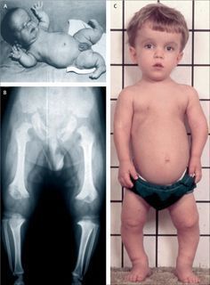 acondroplasia forma común de displasia no mortal 1:20,000 rnv gen FGFR3 cromo.4p16.3 mutación puntual: cambio de G a A novo en la esperma...
