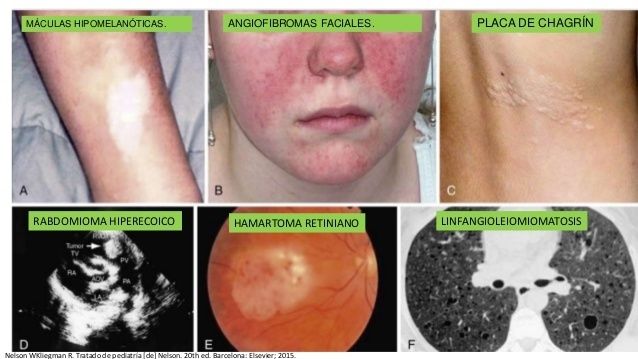 esclerosis tuberosa enf pleiotrica sx neurocutaneo multisistémico 1:5000 a 10,000 rnv TSC1-9 q34 TSC2- 16p13 triada de Vogt (epilepsia, i...