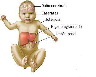 galacosemia herencia autosomica recesiva gen GALT-9p13 GALK1-17q24 GALE-1p36-p38 galactosa-1-fosfato tipos :clasica (1), deficiencia de g...