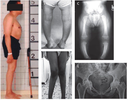 Osteomalacia