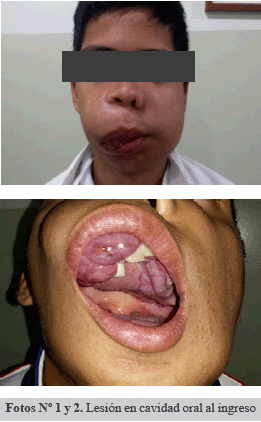 Hiperparatiroidismo (Tumor Pardo)