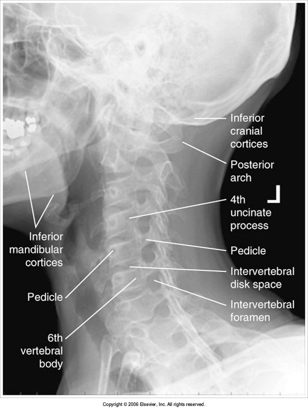 Oblique C-Spine evaluation criteria
