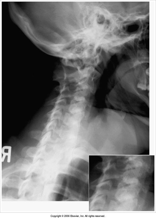 no cephalic angle