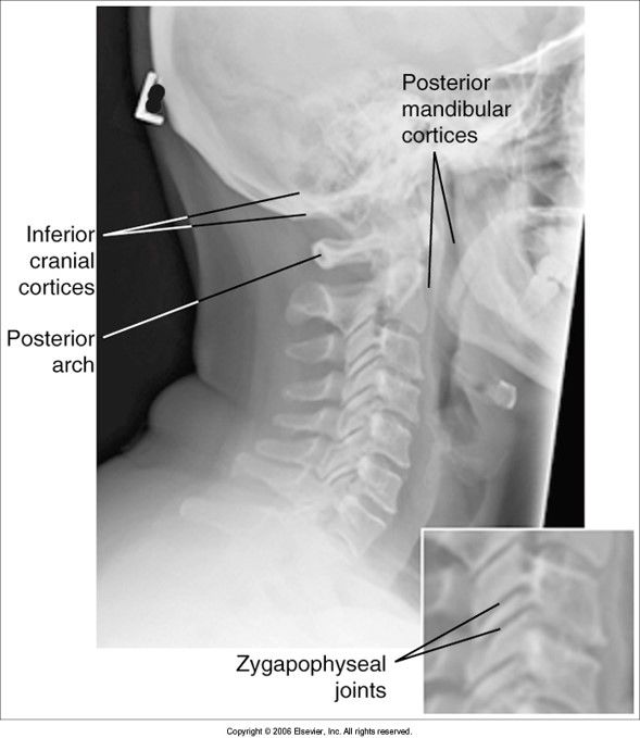 mandibular rami are not superimposed: pt. rotated articular pillars and z. jt.s are separated: pt. head tilted away from IR