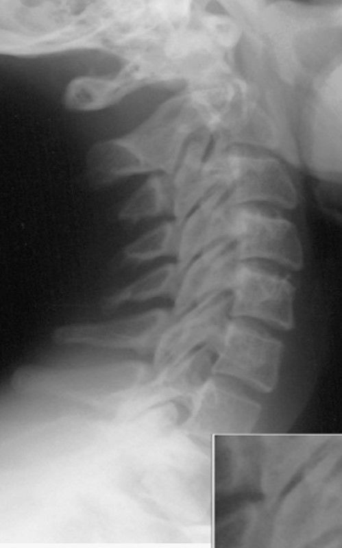 base of skull and sella turcica coned off z. jt.s closed: rotation