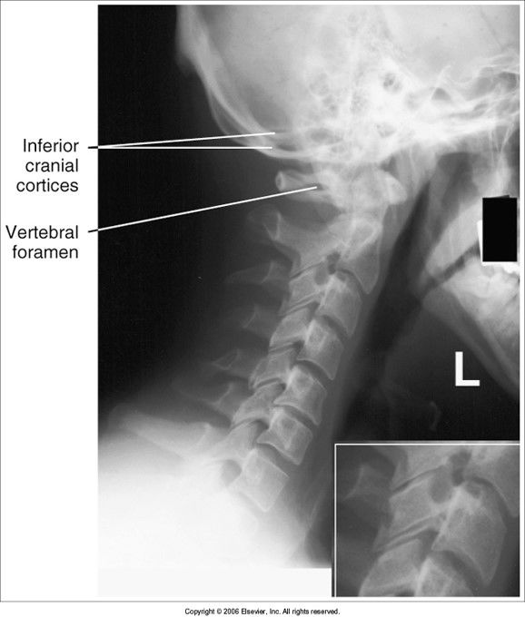 mandible not superimposed: head is tilted z. jt.s are separated