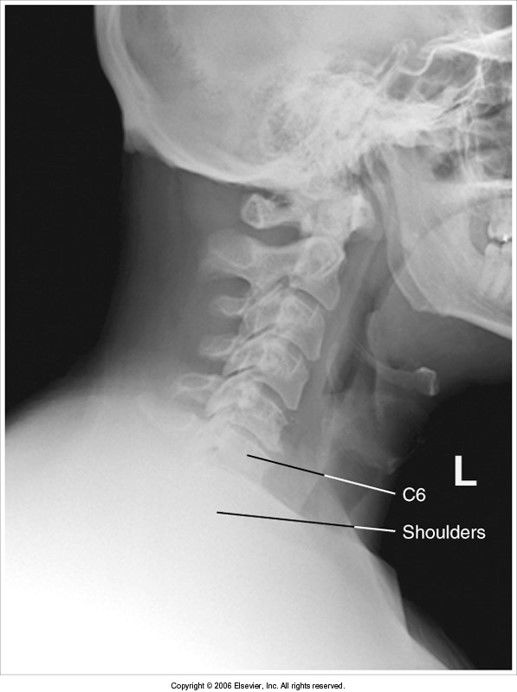 C7 is invisible behind the shadow of the shoulders - give pt weights to relax shoulders down