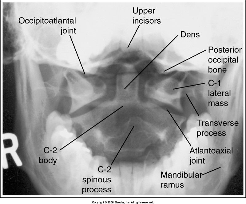 AP Open Mouth evaluation criteria