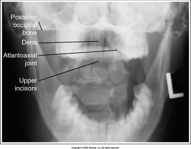 teeth are superimposed over the dens: head is tilted forward