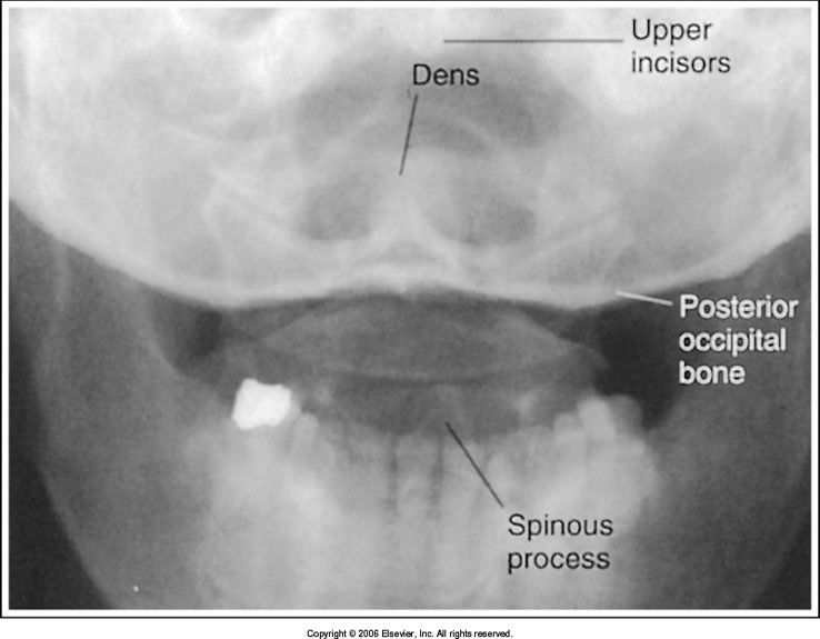 base of the skull superimposes the dens: head is extended too far