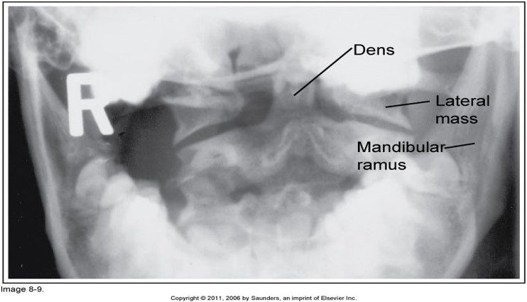 dens is situated to the left of the MSP: pt's head is rotated towards the right