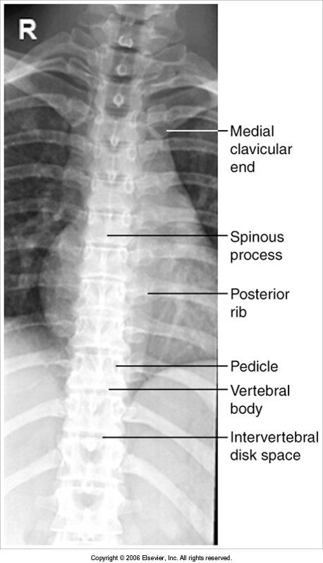 AP Thoracic Spine evaluation criteria