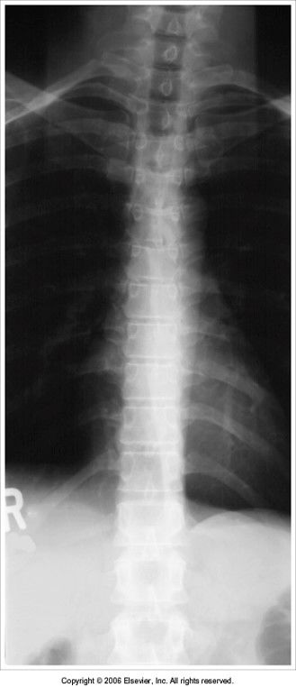 exposure was taken on full inspiration: lung fields are overexposed and density is not well distributed
