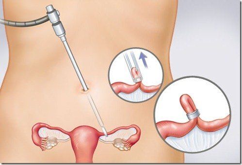 ATENCION EN PLANIFICACION FAMILIAR A HOMBRES Y MUJERES