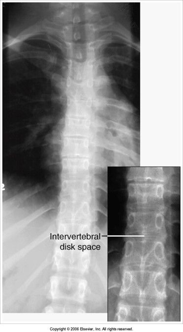 intervertebral joint spaces are obscured: pt's legs/knees were extended when they should've been flexed